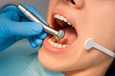 Tratamiento de Endodoncia en Quilpué