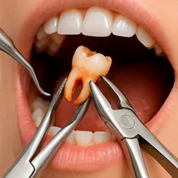 Extracción de Muelas del Juicio en Quilpué